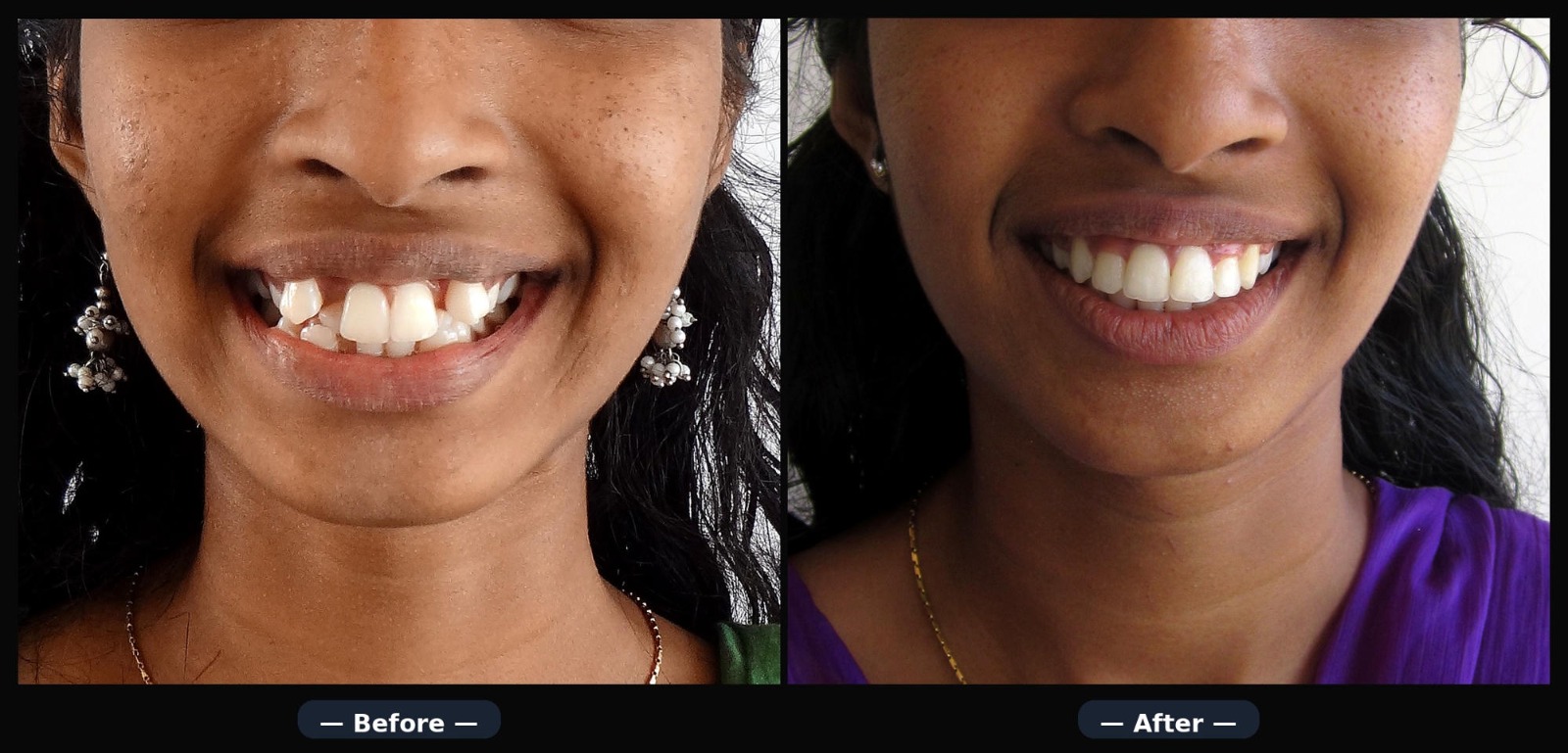 Before and after severe crowding correction with braces